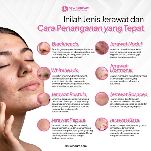 Apakah Jerawat Kulat?